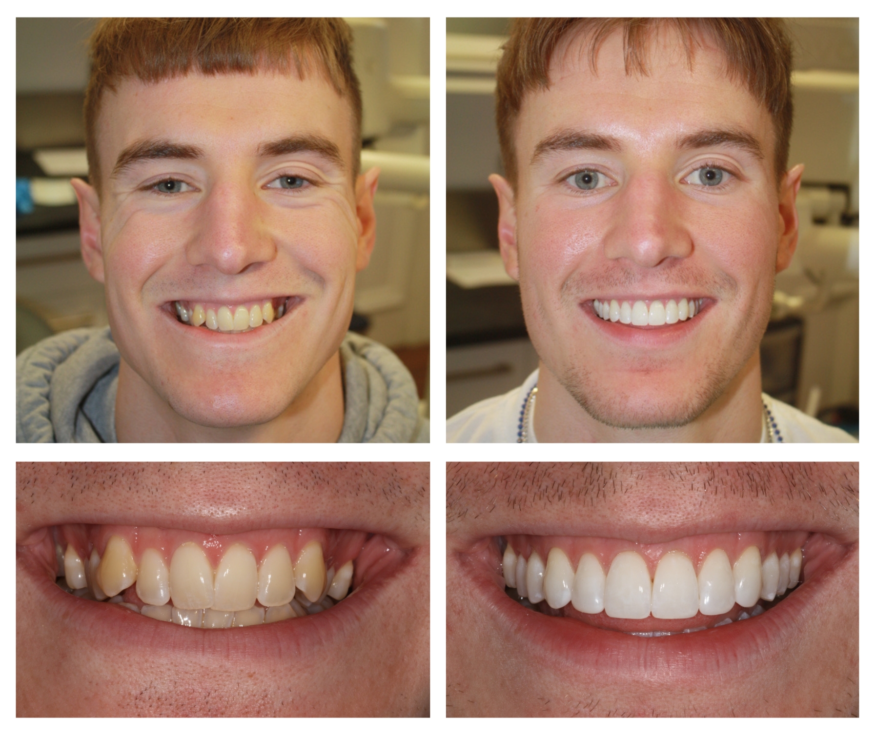 Before and after smile makeover results from cosmetic dentistry